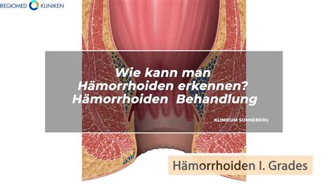 bilder von hämorrhoiden|hämorrhoide identifizieren.